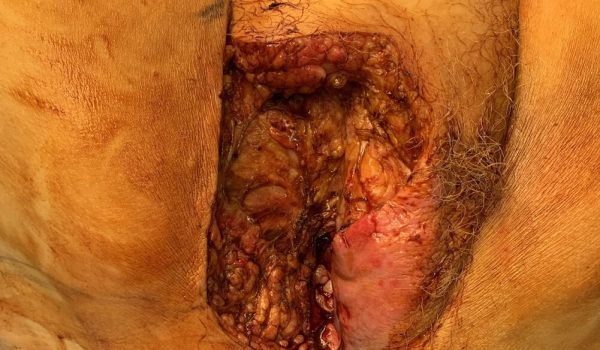 Picture 2: Right radical excision (hemivulvectomy) & separate left inguinofemoral node dissection incision